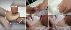 Evaluación arterial

Digito-presión en pulpejo de los dedos o lecho ungueal
Aumento en el tiempo de llenado indica obstrucción arterial