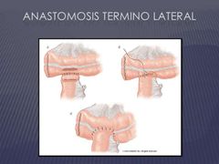 Anastomosis termino-lateral