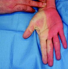 Evaluación arterial

Compresión de arteria radial y cubital o a nivel de la muñeca, con los dedos del examinador. Si la palidez persiste existe algún tipo de obstrucción.