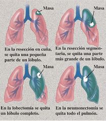 Segmentectomía (un segmento)
Lobectomía (un lóbulo)
Neumonectomía (todo el pulmón)