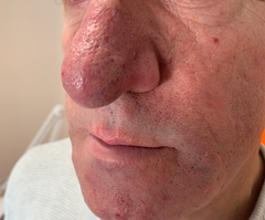 La rosácea es una enfermedad crónica caracterizada por la aparición de eritema y lesiones acneiformes, afectando a mejillas y nariz y más tipicamente a mujeres. La hiperreactividad vascular y el demodex folliculorum se han implicado en su etio...