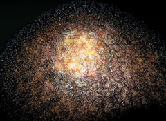Paciente de 32 años que comienza con lesiones descamativas en cuero cabelludo. No cura a pesar de los tratamientos con corticoides intralesionales y en momento actual presenta el aspecto que puede observar en la fotografía con supuración activa...