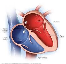 No se cierra el foramen oval(no fusión de septum primum y secundum). Cardiopatía + frecuente.