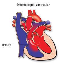 Afecta a la porción muscular del tabique (+ común) o a la porción membranosa. Cx: disnea, retraso del crecimiento, enfermedades respiratorias.