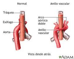 Aorta dorsal derecha persiste. anillo vascular rodea tráquea y esófago. Cx: disfagia y disnea.