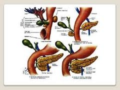 yema ventral en 2, una parte se va por atrás y otra por delante. Anillo alrededor del duodeno. Cx: vómitos, no paso de alimentos.