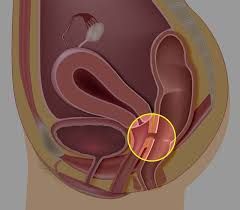 persistencia del conducto vitelino. Comunicación entre ombligo y tracto intestinal.