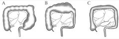 ausencia de ganglios parasimpáticos en pared intestinal. 1/5000. Causa + común de obstrucción intestinal. + frecuente en varones.  + común en colon sigmoides (80%).