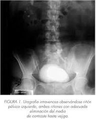 el riñón permanece en la pelvis