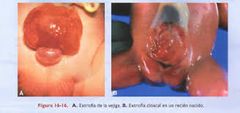 1/10,000-40,000. + frecuente en hombres. Alteración de la pared ventral del cuerpo (mucosa en la vejiga queda expuesta)