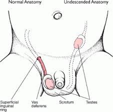 fala de descenso testicular. 30% en prematuros. Se puede encontrar en cavidad abdominal, canal inguinal, re escrotal.