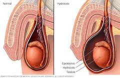 cumulo de líquido en cavidad escrotal. Causado por la obliteración anormal entre cavidad abdominal y saco escrotal (quistes).