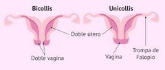 no se fusiona el conducto de Müller. Útero dividido por un tabique. Alto riesgo de aborto