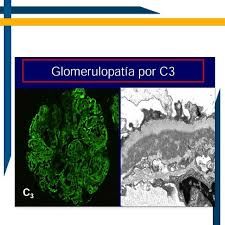 *Glomerulonefritis membranoproliferativa
* Enfermedades por depósitos densos
* Nefropatía IgA
* Glomerulonefritis crónica