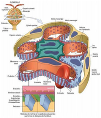 Es una enfermedad que produce engrosamiento de la pared capilar glomerular por deposito de Ig  en la parte subepitelial de la membrana basal. Lo cual produce infecciones de (VHB, VHC, sífilis, paludismo,
tumores ,pulmón, melanoma, colon).