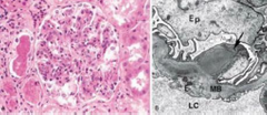 Esta enfermedad se caracteriza por el aumento de la celularidad del glomérulo debido a la entrada
(exudado) de leucocitos que intervienen en su formación