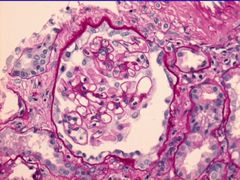 En esta enfermedad no hay aumento  de la celularidad, es decir, no predomina la
presencia de células inflamatorias del tipo monocitos, macrófagos, neutrófilos como
en la nefritis aguda.