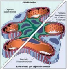 Se depositan en el glomérulo
tanto IgG como factores del complemento. Toda esta enfermedad puede estar relacionada con el LES,
CHB, VHC, VIH leucemia linfática crónica.