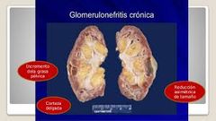 Esta se ocasiona  por varios tipos específicos de glomerulonefritis o que puede desarrollarse  de las  glomerulonefritis aguda.