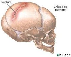 Las meninges pueden quedar atrapadas en una fractura lineal de cráneo con el posterior desarrollo de un quiste leptomeníngeo y crecimiento de la fractura original (fractura en expansión)