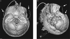 ¿A qué diagnóstico de muerte cerebral se refiere la imagen? Este utiliza un tinte especial y rayos X para ver cómo fluye la sangre a través del cerebro.