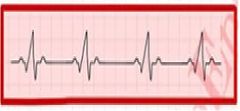 La siguiente Imagen es un ejemplo de un ritmo cardiaco: