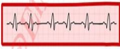 La siguiente Imagen es un ejemplo de un ritmo cardiaco: