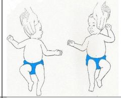 1- Reflejo tónico cervical asimétrico (TCA) “el 
esgrimista”
ESTIMULO - Con él bebe de cubito supino/dorsal, se gira el cuello del bebe hacia los lados
REAccion - El brazo que está del lado hacia donde mira la cabeza realiza una extensión...
