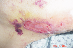 What is the etiology of this wound?