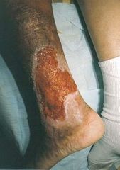 Gangrena Gaseosa / Mionecrosis= En heridas traumáticas que se pueden contaminar por Esporas o microbiota oportunista. 
Por toxina alfa (α) ➡ Necrosis y edema, Hay dolor, presión, pesadez ➡ decoloración y gas en la herida. 
Síntomas sisté...