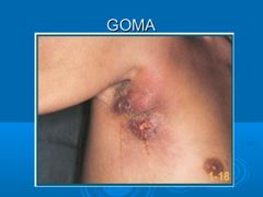 GOMA
Nódulo con las siguientes fases: Formación > reblandecimiento> Ulceración/Fistula > cicatriz