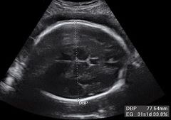 Diámetro biparietal

Para medir este diámetro se debe congelar la imagen ecográfica en el plano axial/transversal de la cabeza fetal de manera que se puedan identificar las siguientes estructuras:

-Tercer ventrí****
-Tálamo
-Los huesos del c...