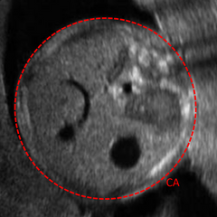 Circunferencia abdominal