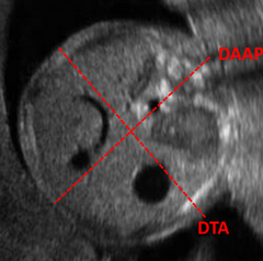 Diámetro Abdominal Anteroposterior