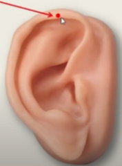 Localización:
Porción interna y externa del ápice de la oreja, por debajo o sobre el PR 2, respectivamente.