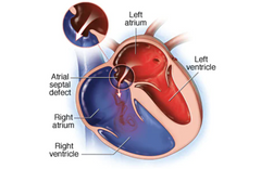 - Comunicación interauricular (CIA) persistente-