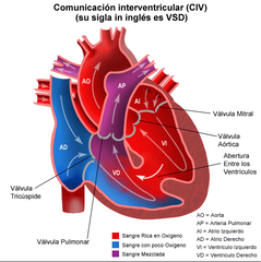 - Comunicación interventricular (CIV) persistente: