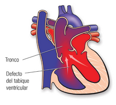 - Tronco arterioso persistente