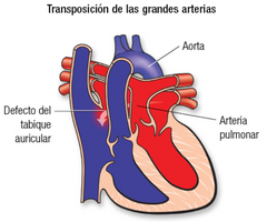 - Transposición de grandes vasos