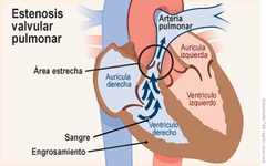 - Estenosis aórtica y pulmonar