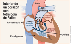 - Tetralogía de Fallot