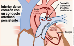 - Ductus arterioso persistente