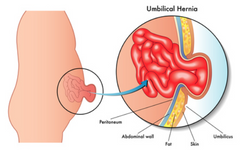 - Hernia umbilical congénita