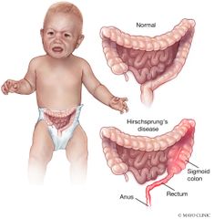 - Megacolon agangliónico