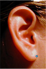 Localización:
Donde el lóbulo de la oreja, se une con la cara .