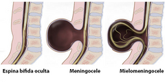 - Espina bífida oculta