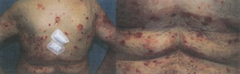 Mujer de 80 años. Lesiones pruriginosas en cuello y EE.

Sospecha diagnóstica, que prueba y tratamiento