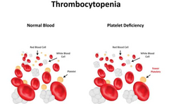 Trombocitopenia