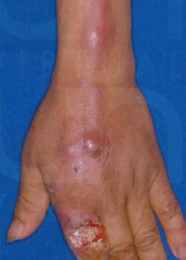 Antecedente de jardinería + infección de EESS a través de una herida con linfangitis asociada