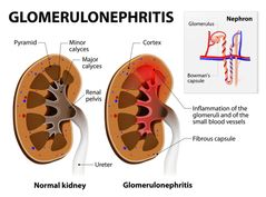 Insuficiencia renal crónica, hiperpotasemia, acidosis metabólica, síntomas urémicos